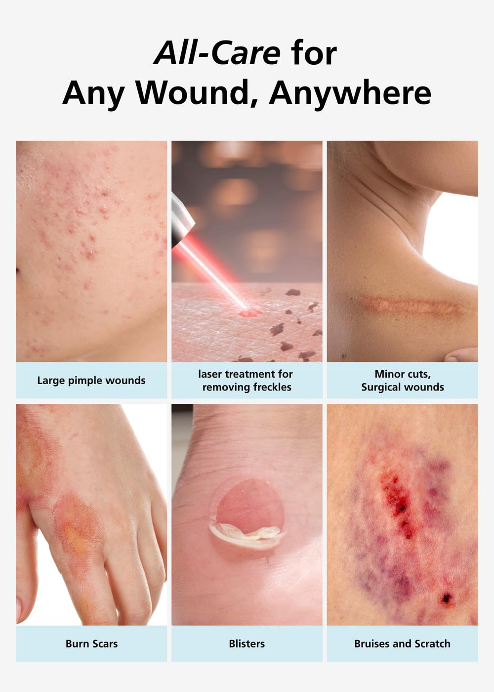 Latex-free hydrocolloid dressing minimizes irritation for sensitive skin.