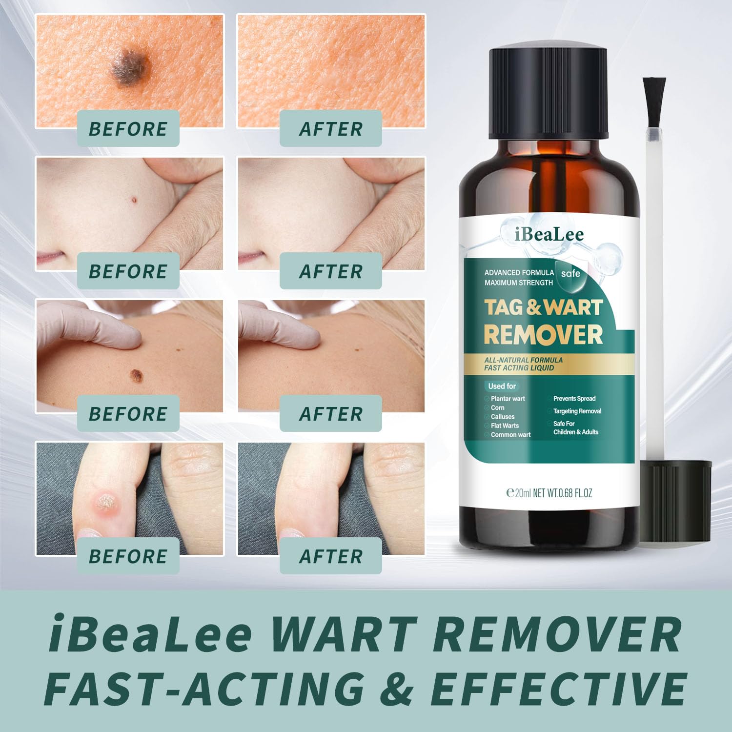 ELEFOCUS Wart Remover Liquid drops applied for targeted wart care.