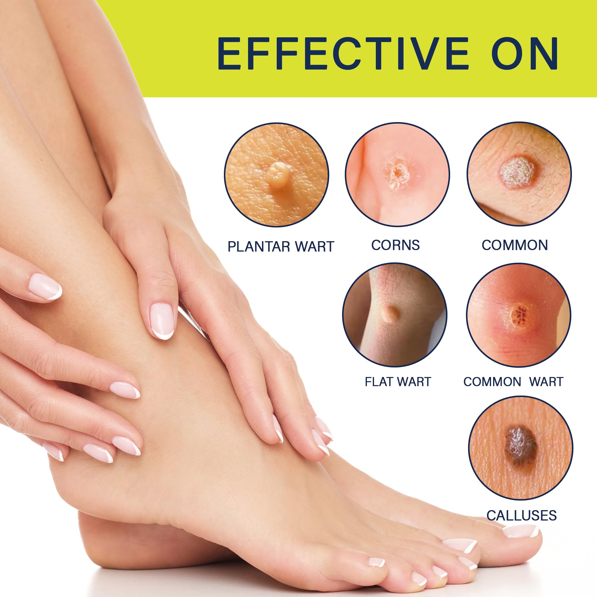 Elsophie plantar wart treatment suitable for feet and hard skin