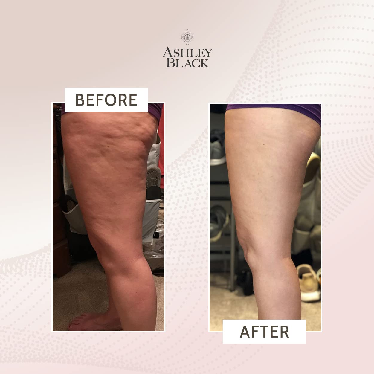 ProBlaster used on leg area to illustrate full-body fascia treatment possibilities