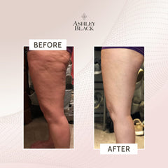 ProBlaster used on leg area to illustrate full-body fascia treatment possibilities