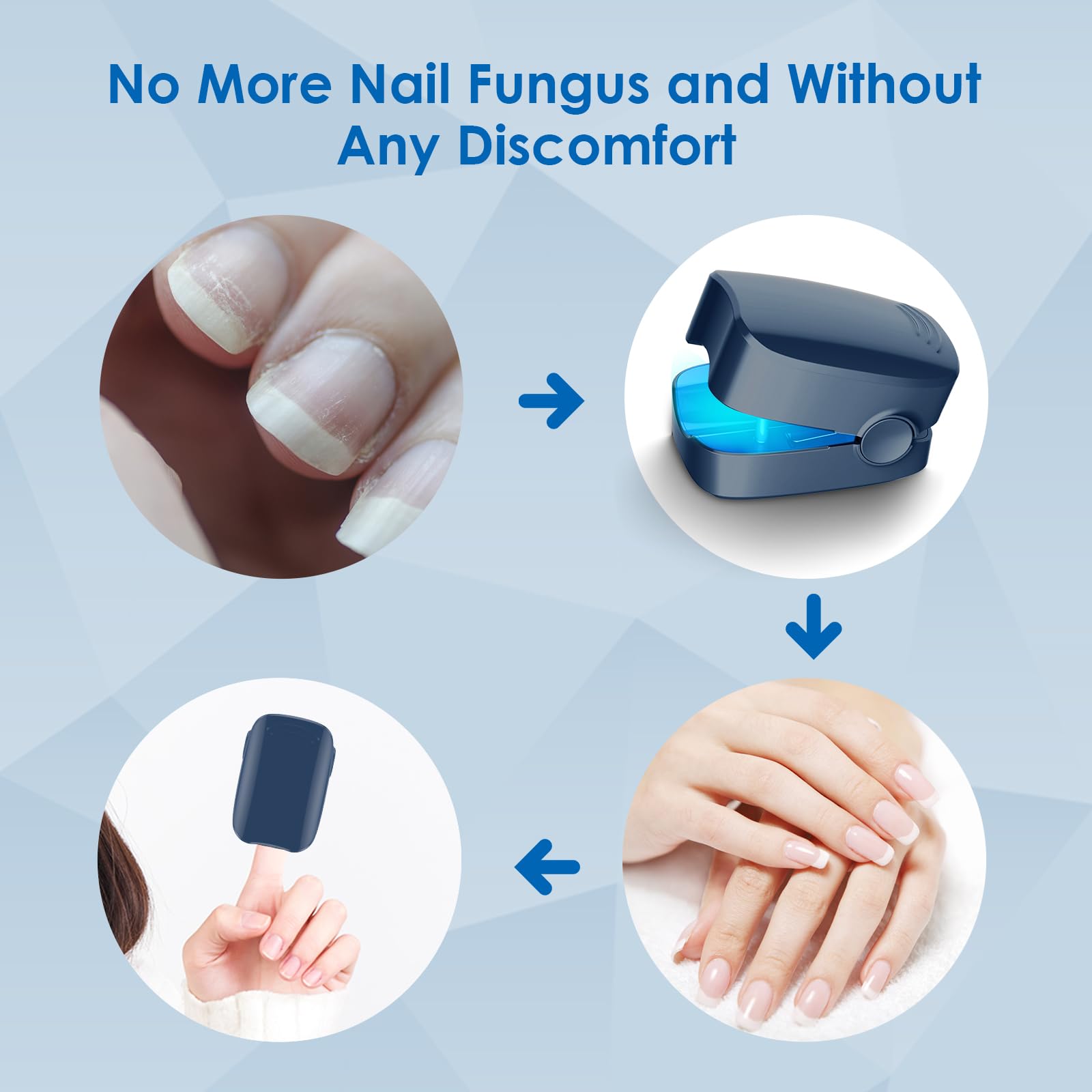 FEIGOMA Home treatment progress image suggesting potential nail improvement