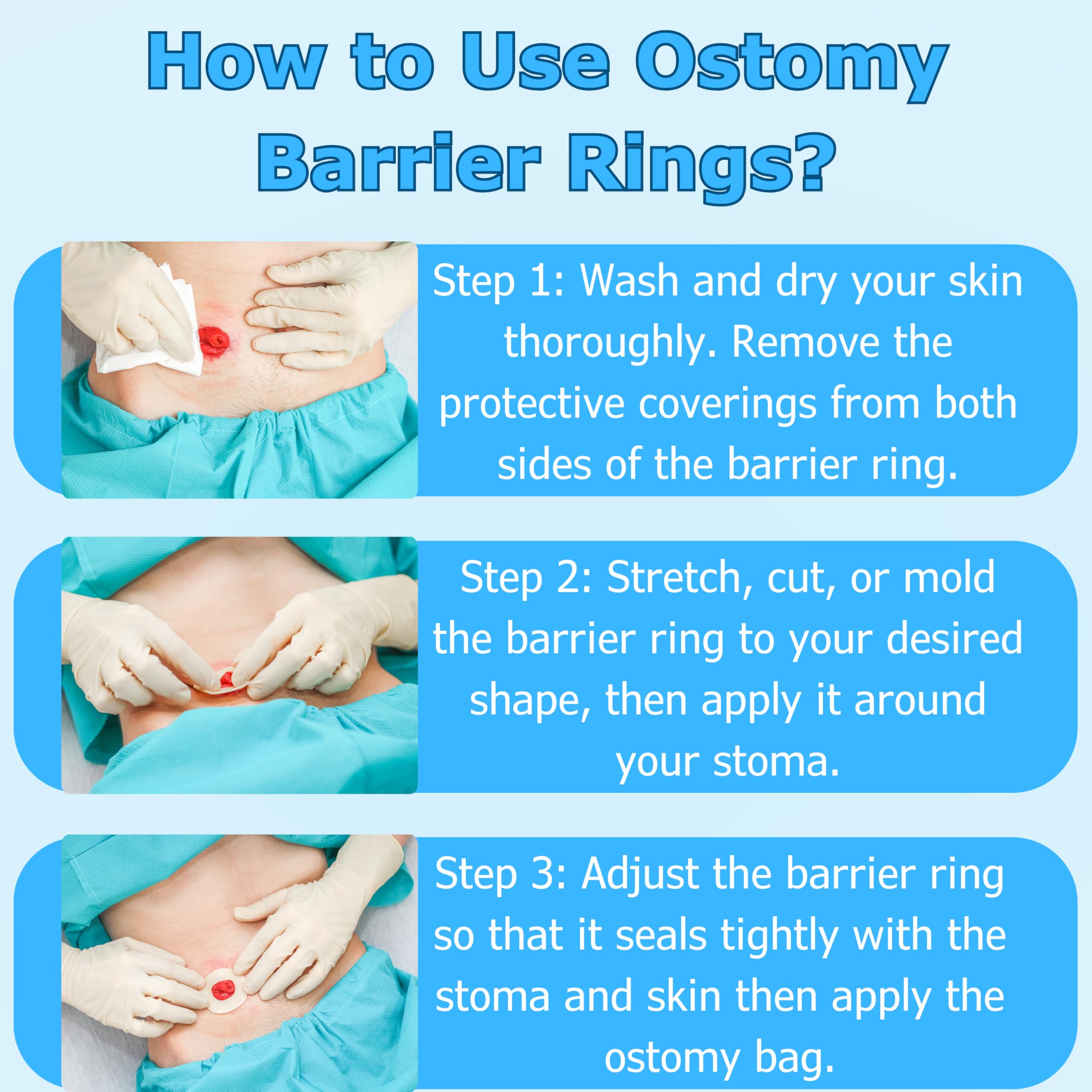 Filigan 20-pack ostomy barrier rings packaged for easy storage and ready use.