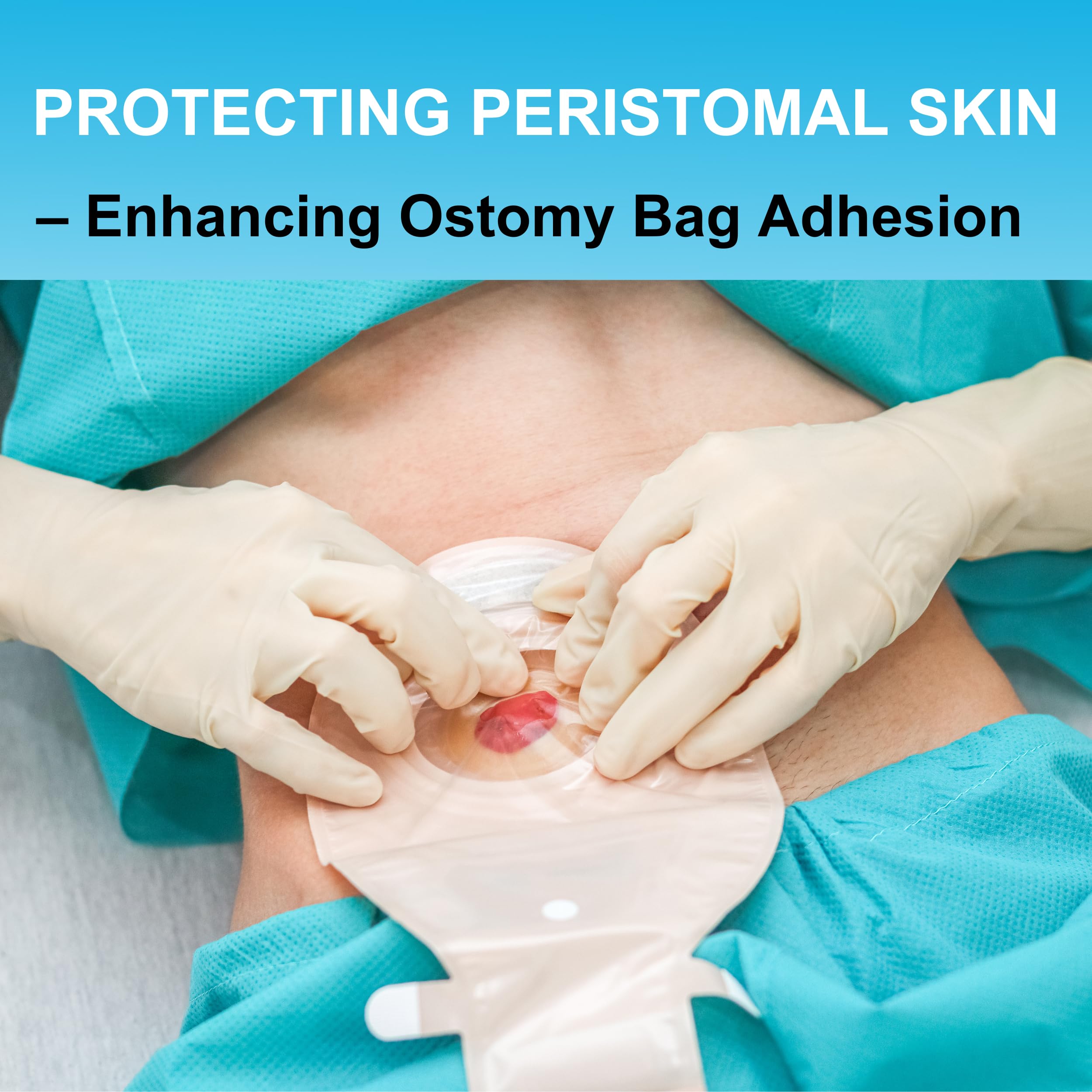 Filigan universal compatibility fits most ostomy pouches and bags.