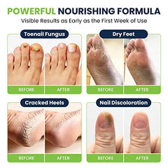 Foot Cure callus remover gel smooths rough patches for comfortable feet.