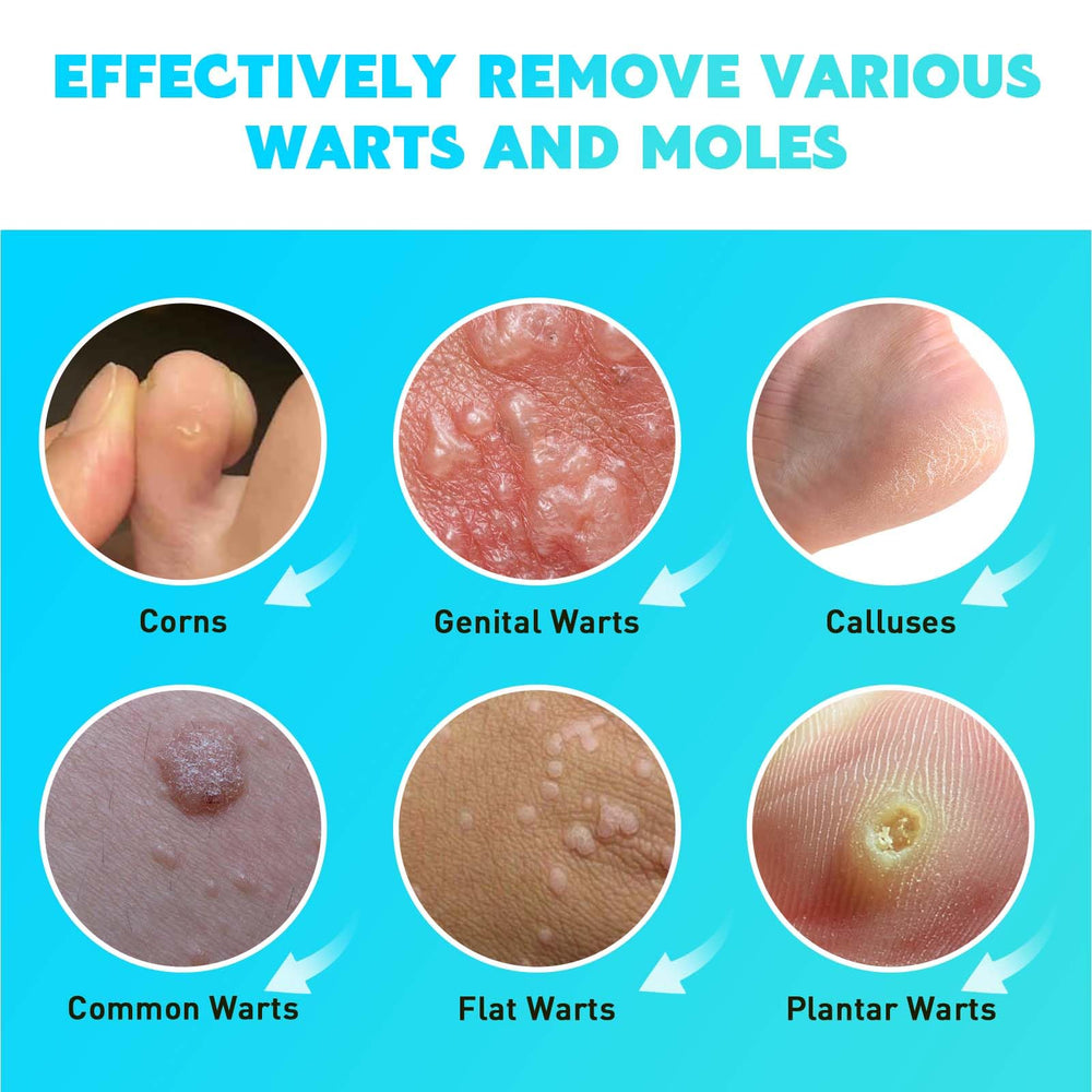 Gaayou Wart Removal application tip in use on skin.