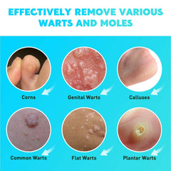 Gaayou Wart Removal application tip in use on skin.