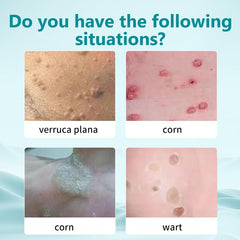Generic Wart Freeze Off applied to common wart area on hands