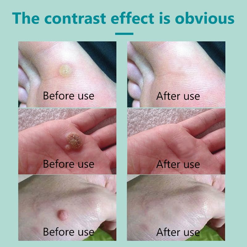 Generic Wart Freeze Off on corn-area spot for home care