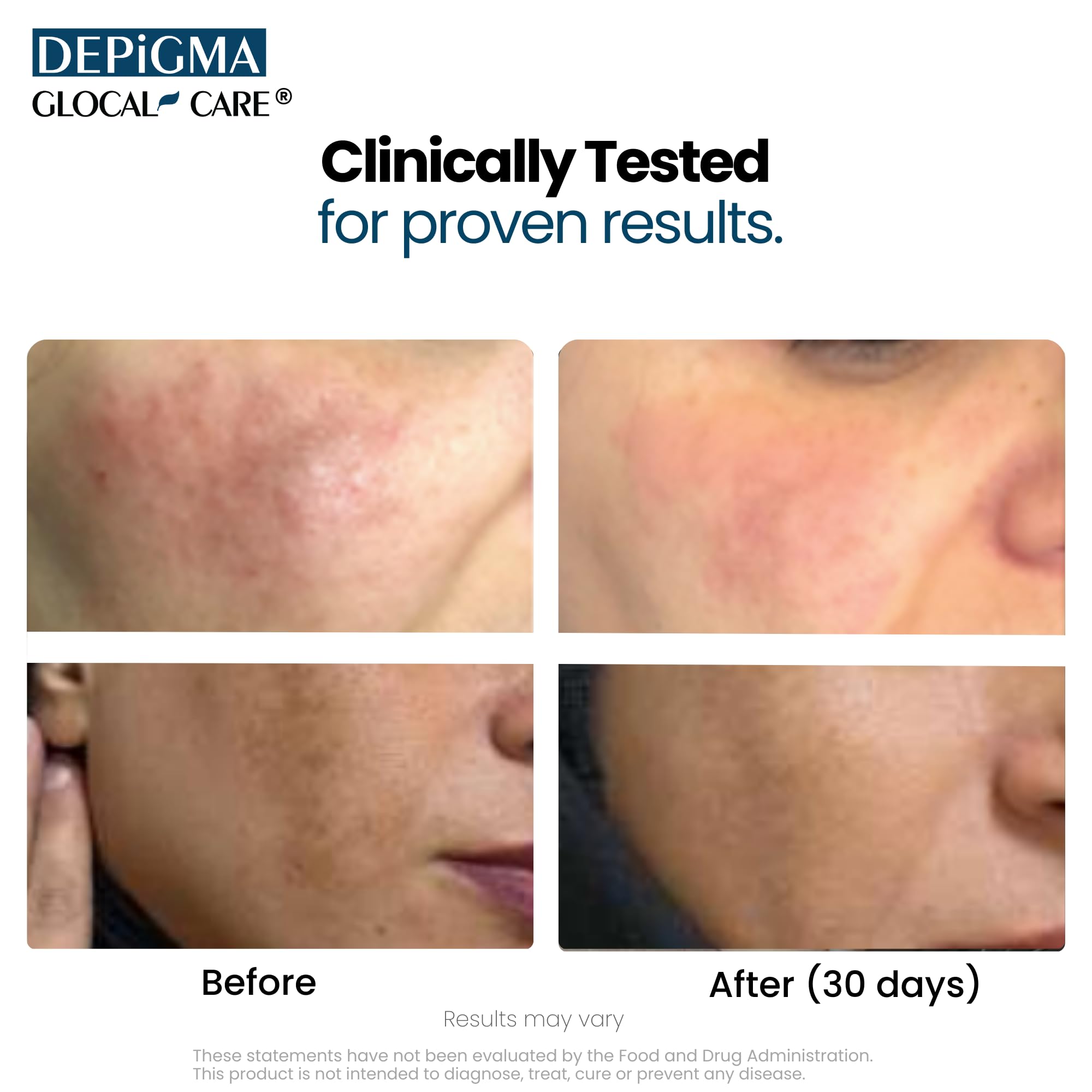 GlocalCare Depigma glutathione bottle emphasizing antioxidant skin luminosity.