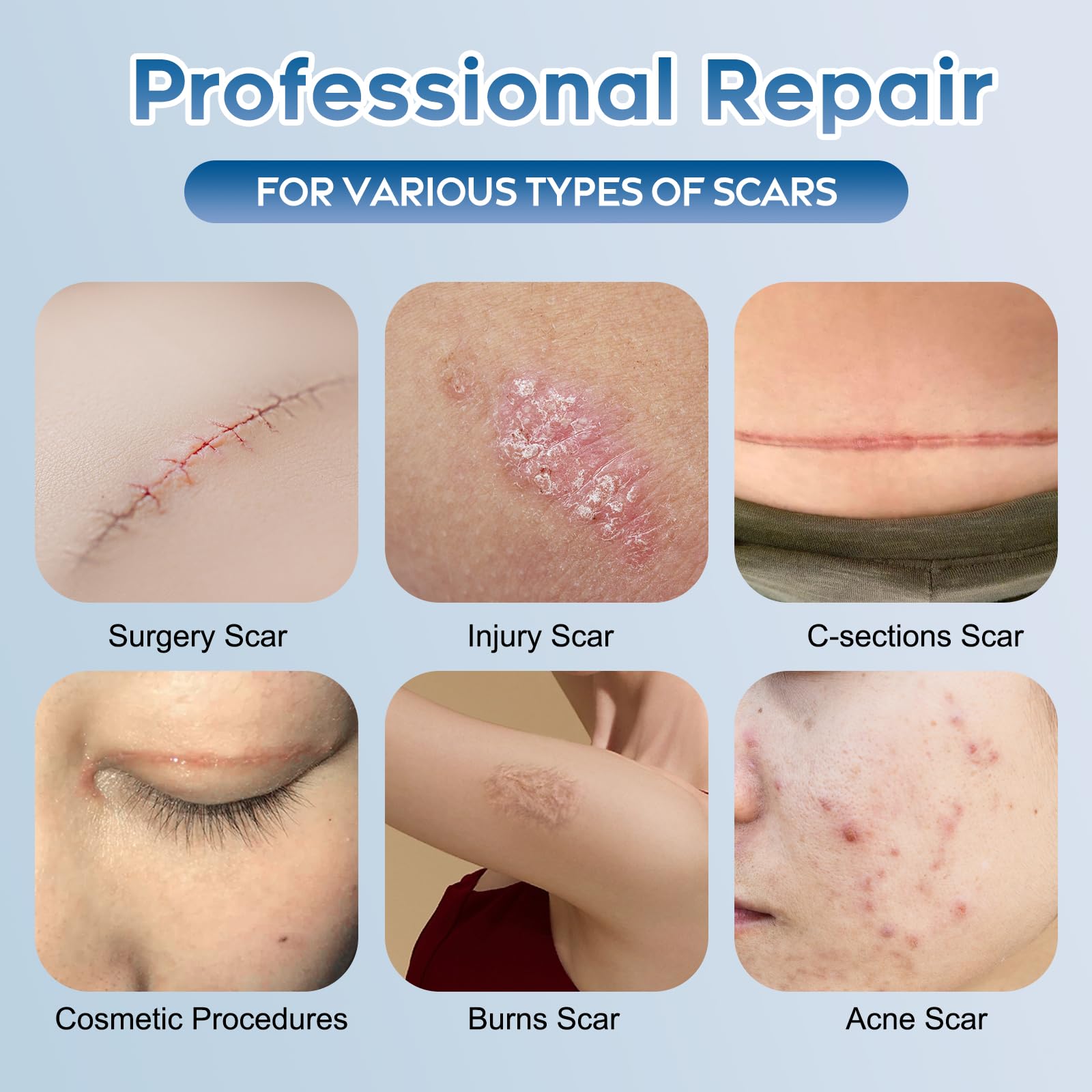 Glowor scar gel applied to scar during daily routine.