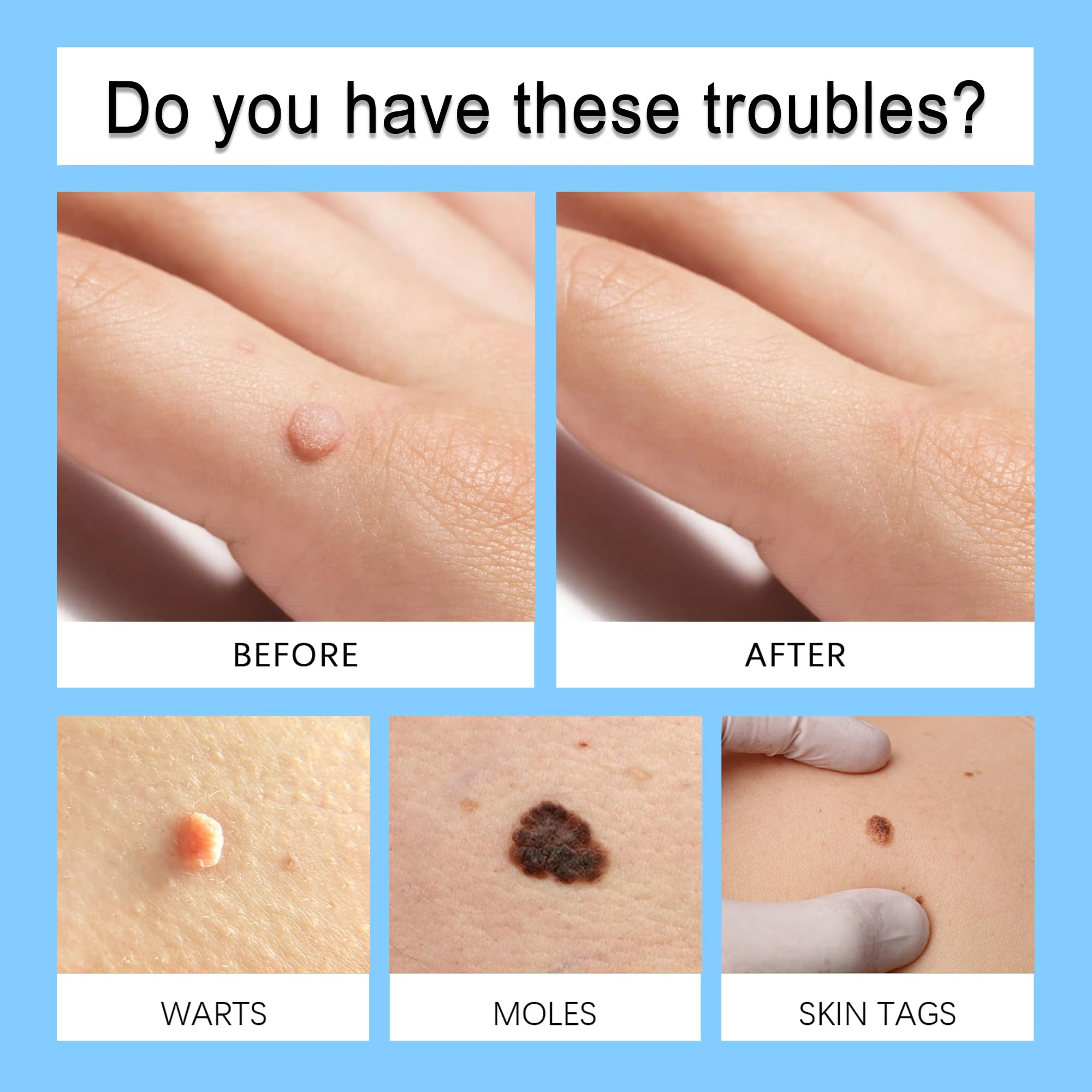 Gonnjunm Wart Care Pen bottle focuses on natural extracts for mild skin care.