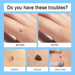 Gonnjunm Wart Care Pen bottle focuses on natural extracts for mild skin care.