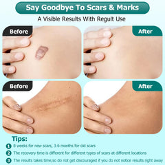 Gowgaw Scar Gel used on arms and legs for broad scar care