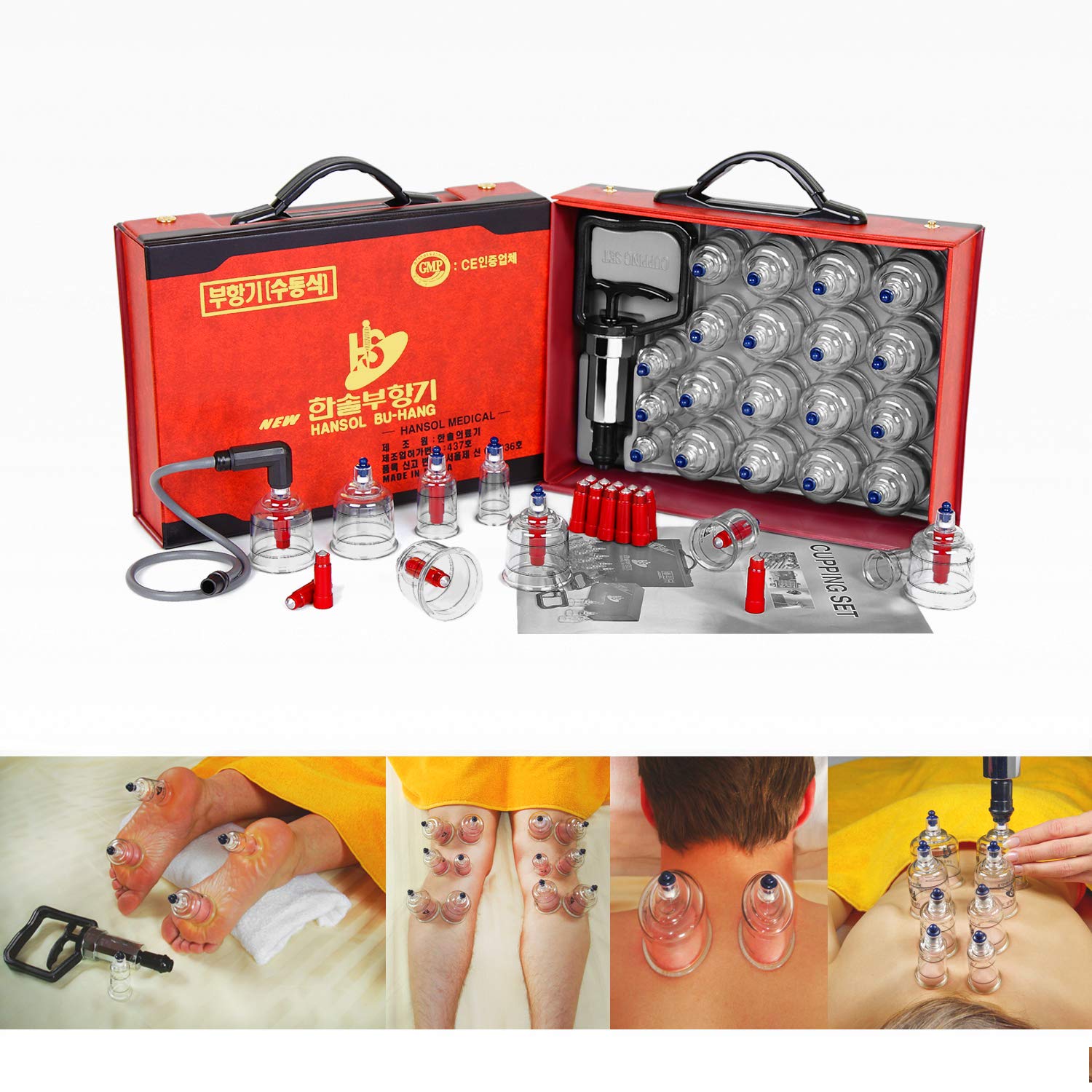 Hansol Medical cupping set in use demonstrating suction with pump
