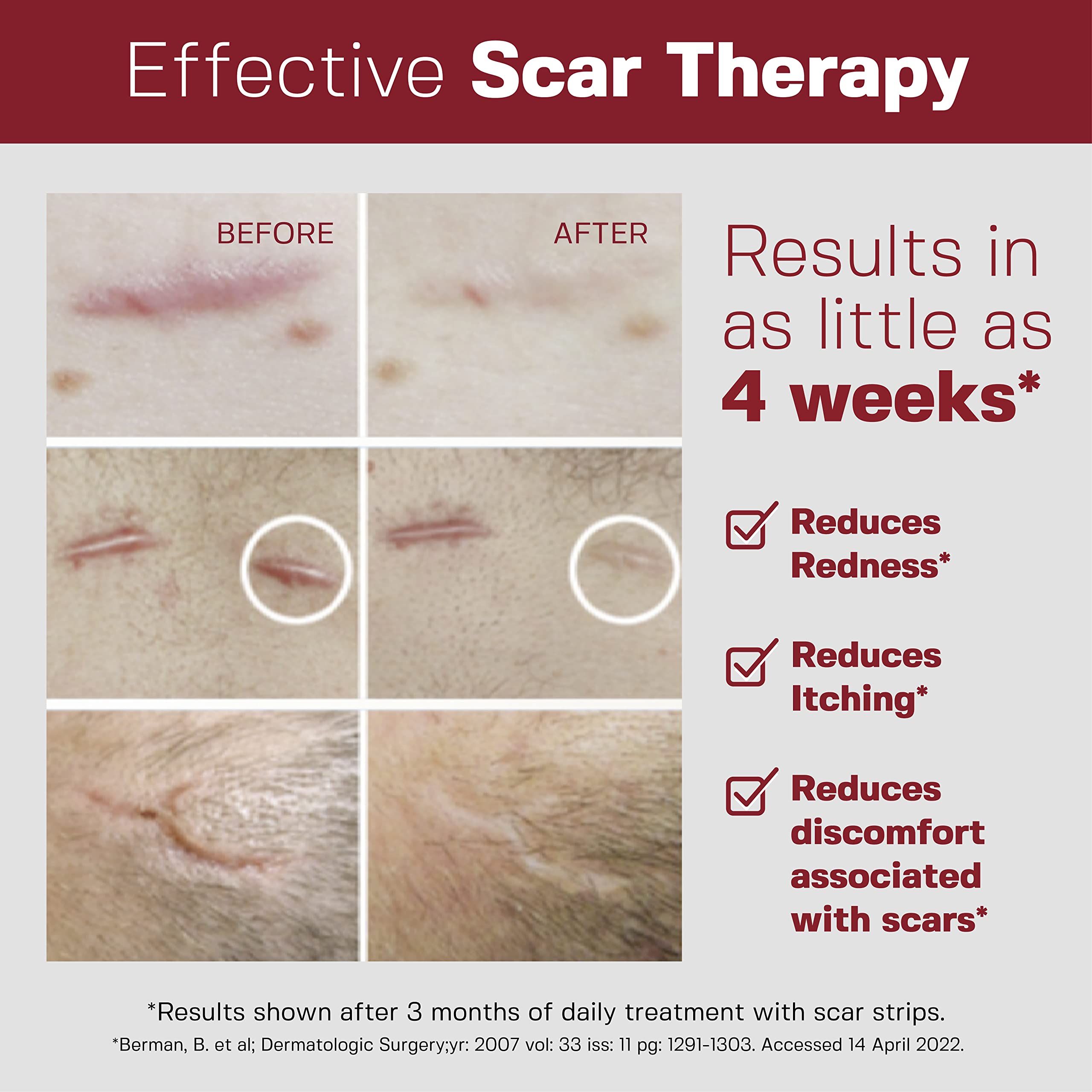 HealFast silicone scar strips for hypertrophic scars aim to reduce raised areas and discoloration.