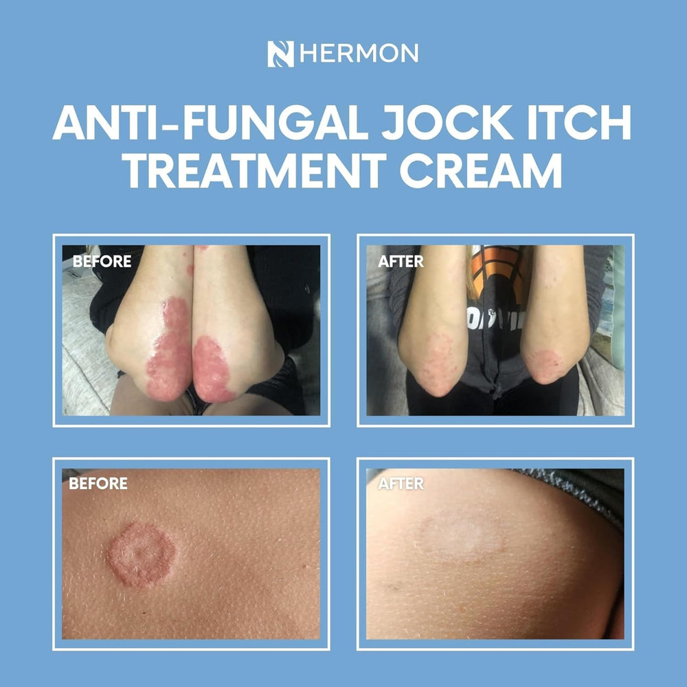 Hermon Jock Itch Cream label emphasizes gentle care for sensitive skin.