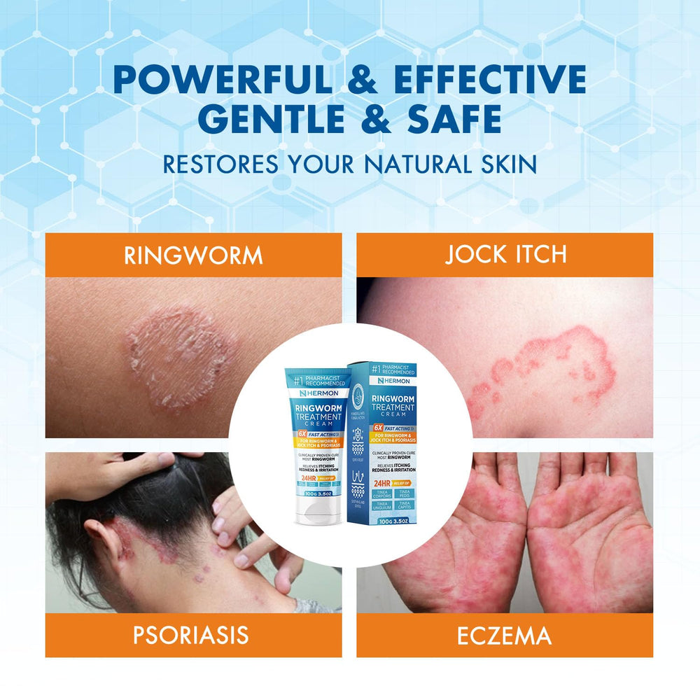 Hermon ringworm cream applied on skin with quick absorption