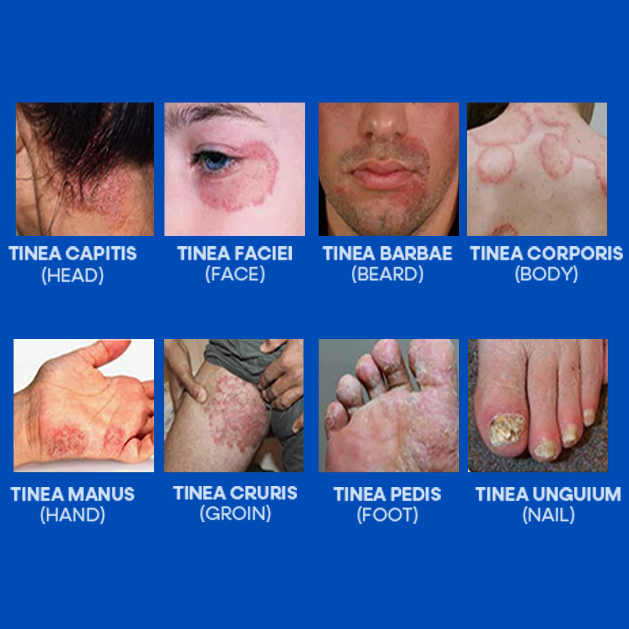 Hermon ringworm cream in family setting for adults and kids