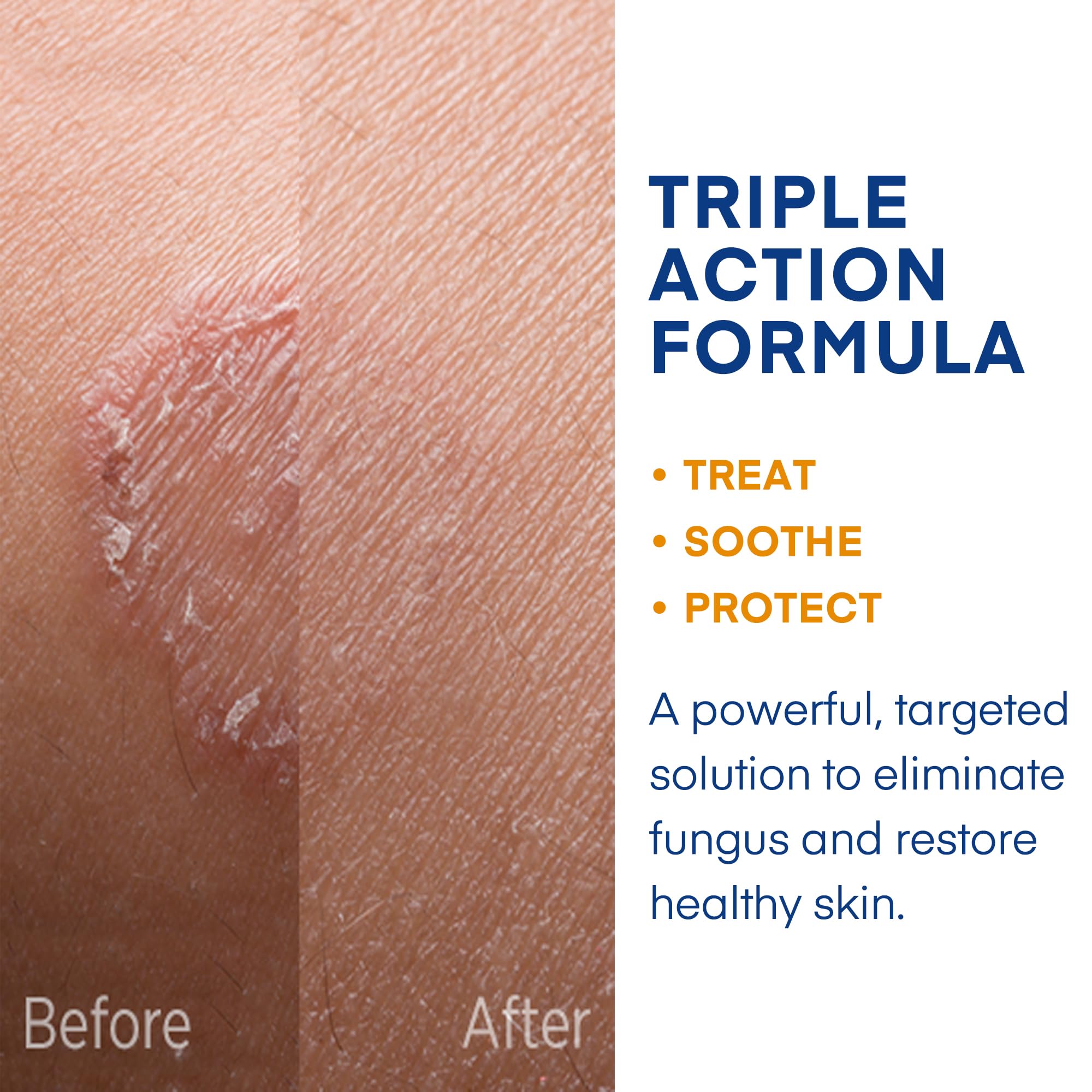 Hermon ringworm cream product hero image with label and texture