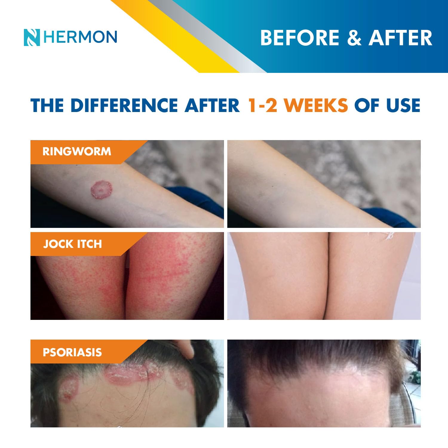 Hermon ringworm cream tube dispensing close-up highlighting easy application