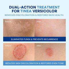 Hermon Treatment Kit Packaging showcases a complete, convenient multi-step care solution