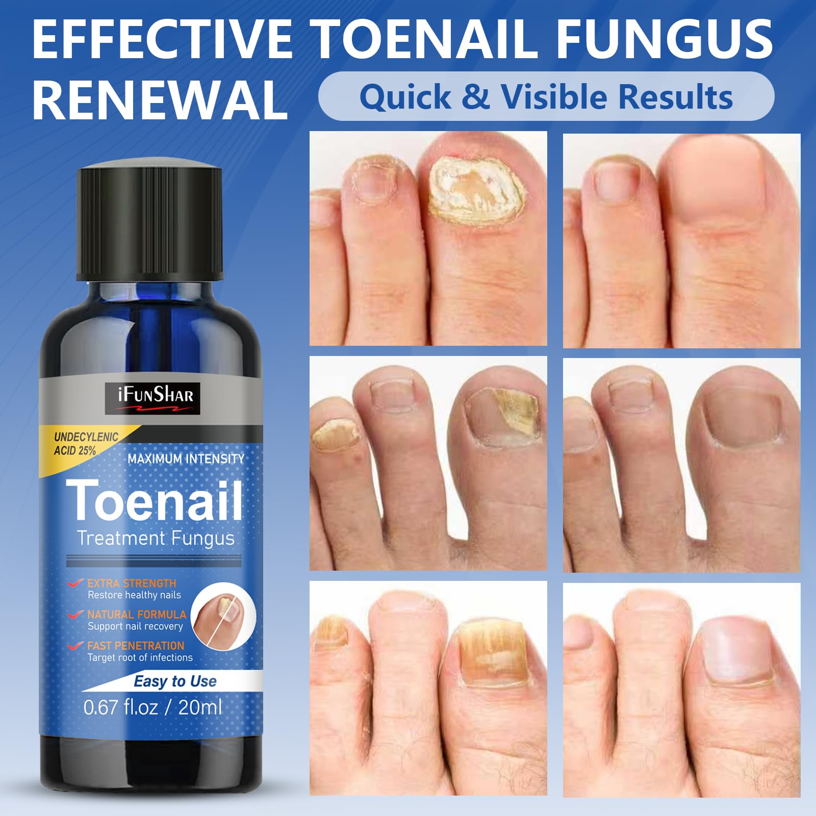 Close-up of IFUNSHAR nail surface application on the affected area