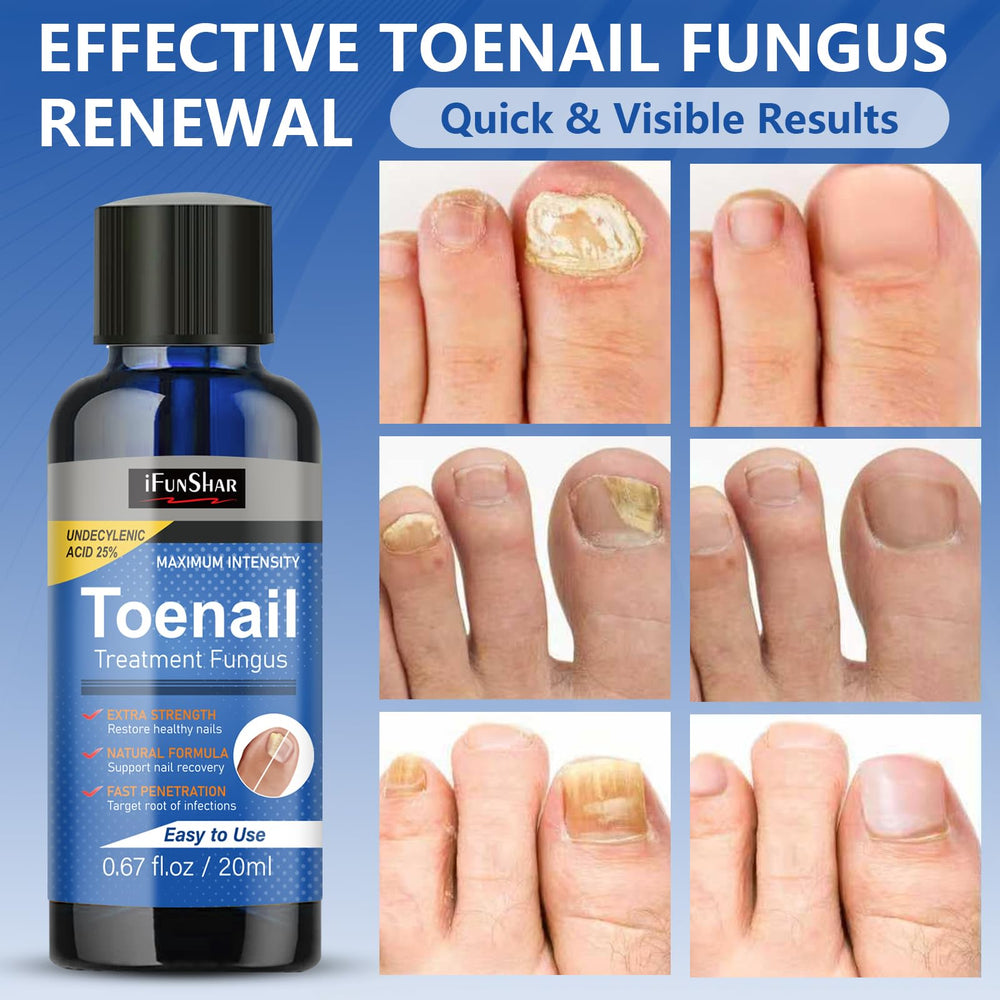 Close-up of IFUNSHAR nail surface application on the affected area