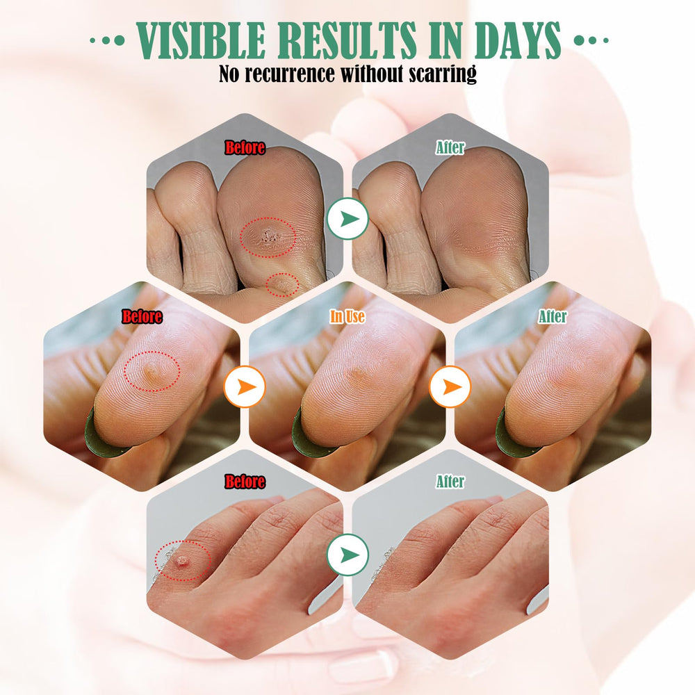 Isalevos pad between toes covers small calluses for comfortable wear