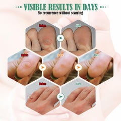 Isalevos pad between toes covers small calluses for comfortable wear