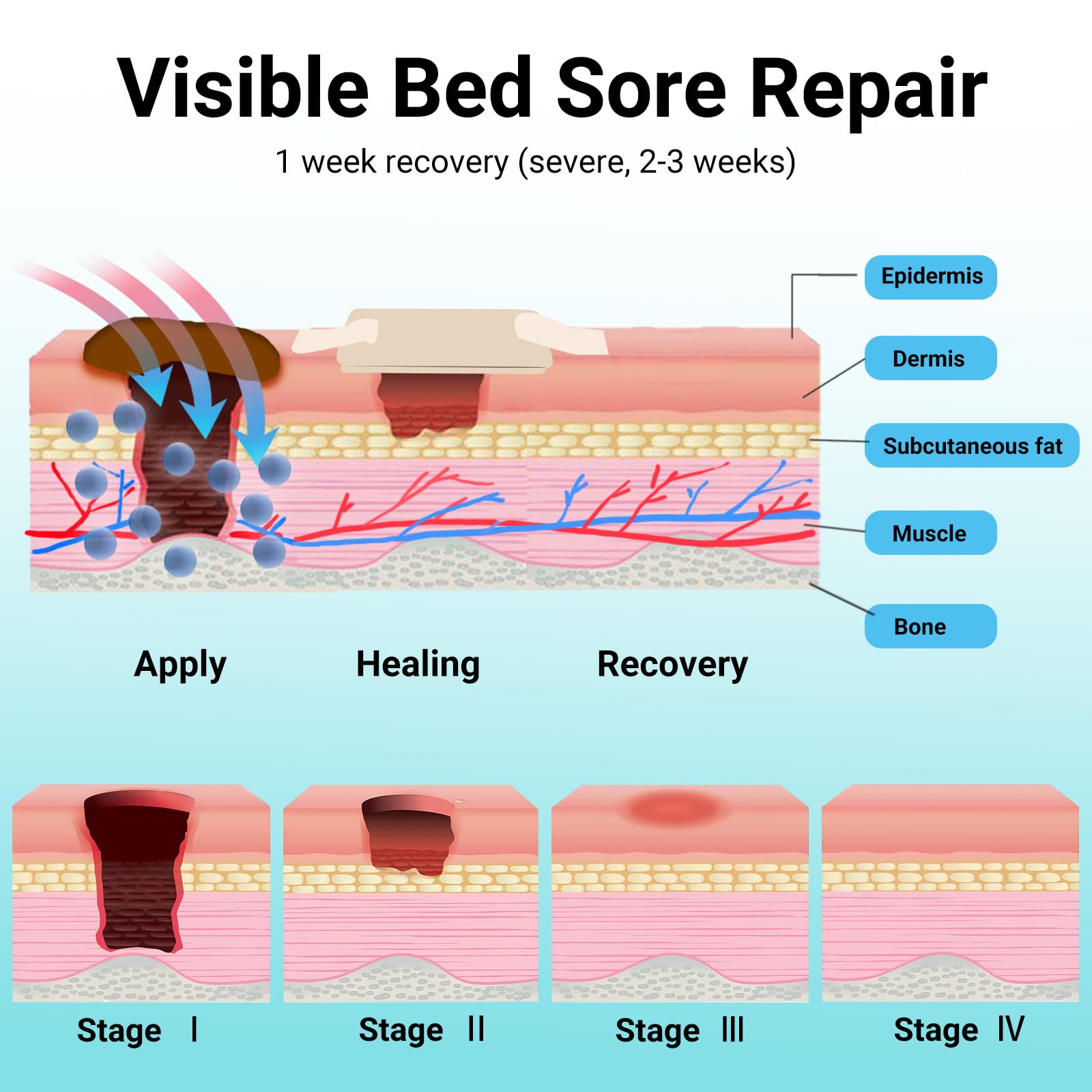 ishancare Bed Sore Cream provides moist therapy to support skin recovery