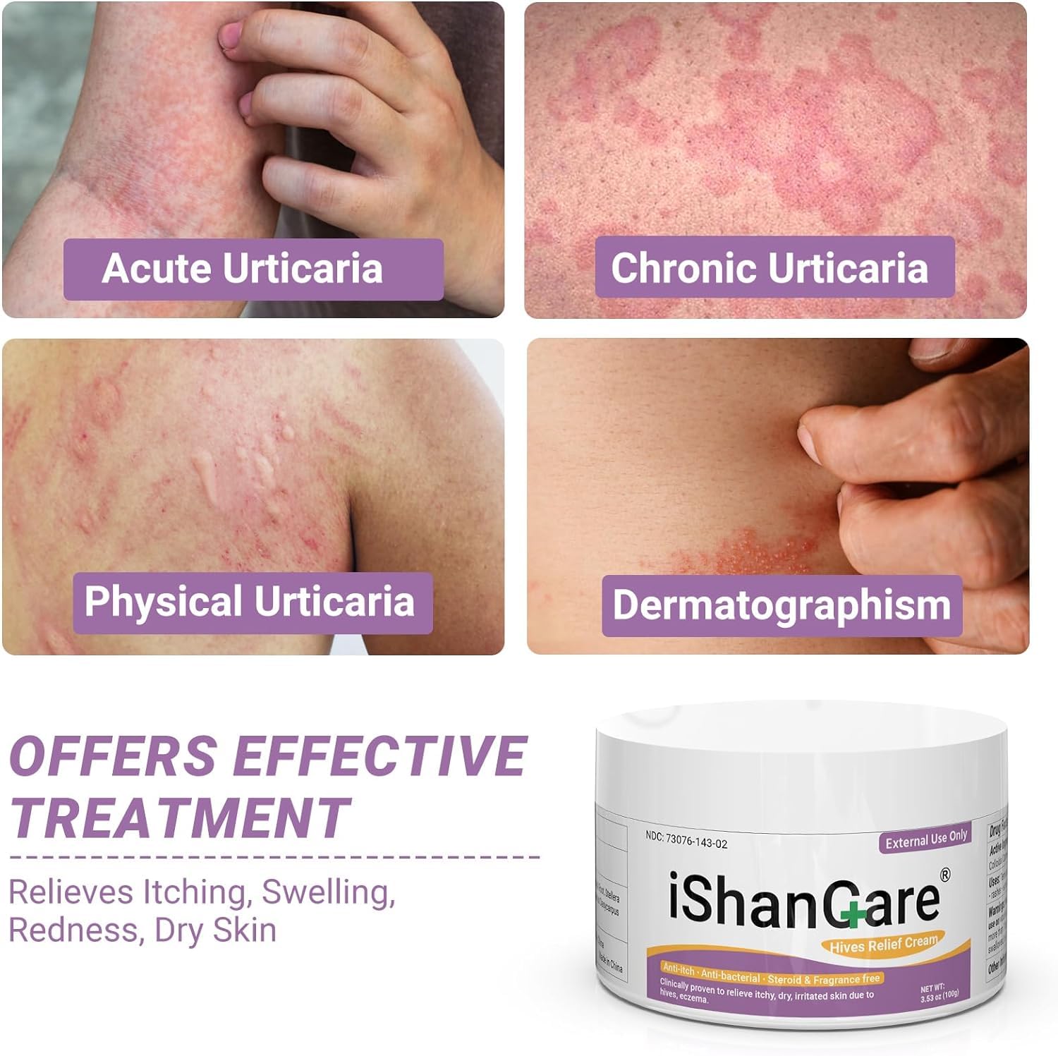 iShanCare Urticaria Cream label closeup highlighting natural ingredients.