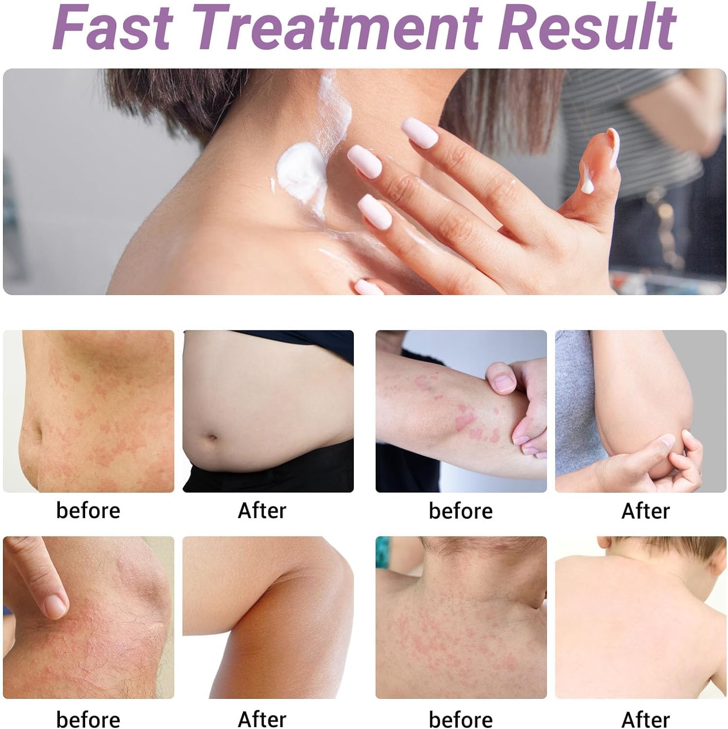 iShanCare Urticaria Cream natural ingredients emphasize gentle care.