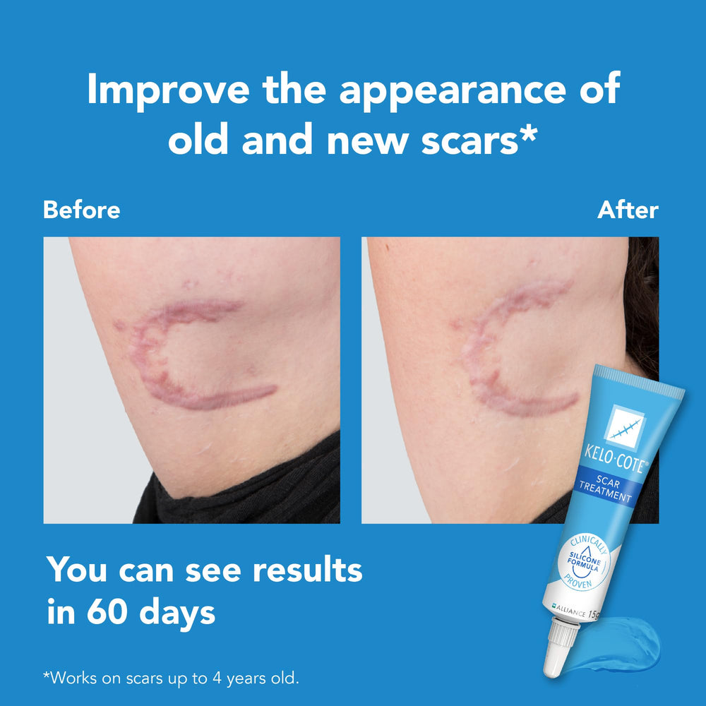 KELO-COTE Sinclair gel for scars discreet finish on skin during wear.