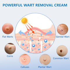KIbabyDI Wart Remover Freezing Therapy Tube for precise wart treatment