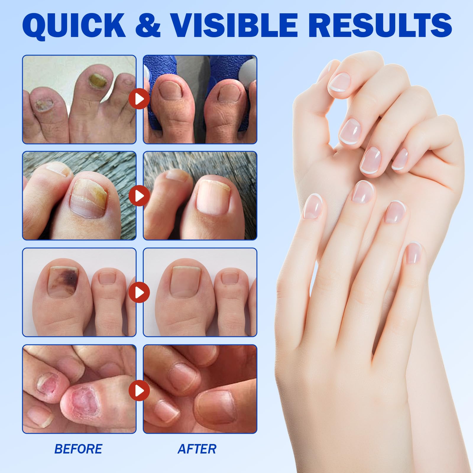 KITNOBLIS hydrogel penetration technology highlights deep nail repair