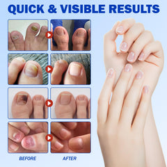 KITNOBLIS hydrogel penetration technology highlights deep nail repair