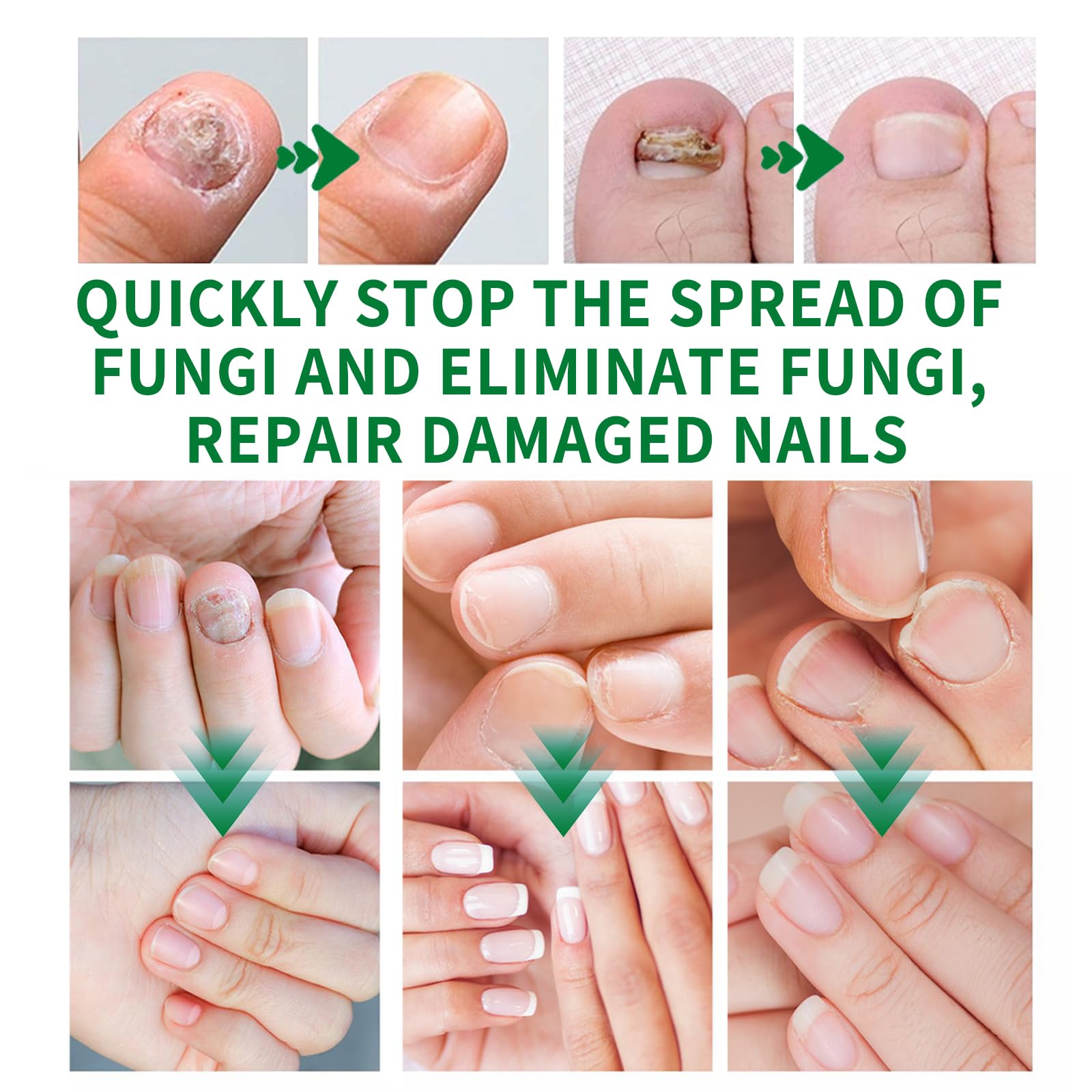 KUNLEN Nail Fungus Gel easy daily application and massage for absorption