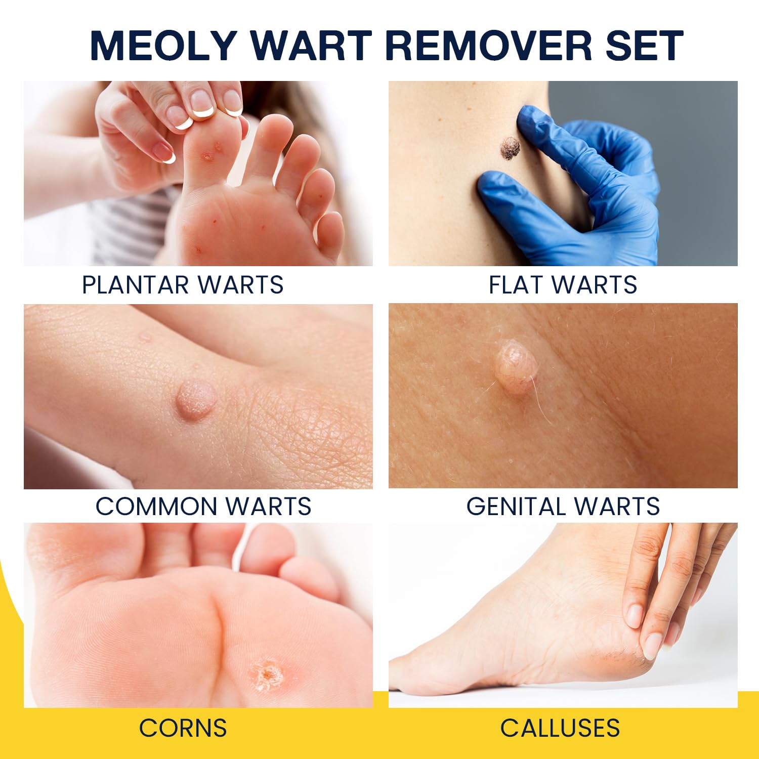 MEOLY thick cushioning pads protect surrounding skin during treatment