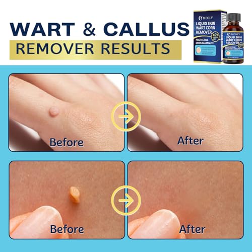 MEOLY Wart Remover packaging box with clear usage directions for shoppers.