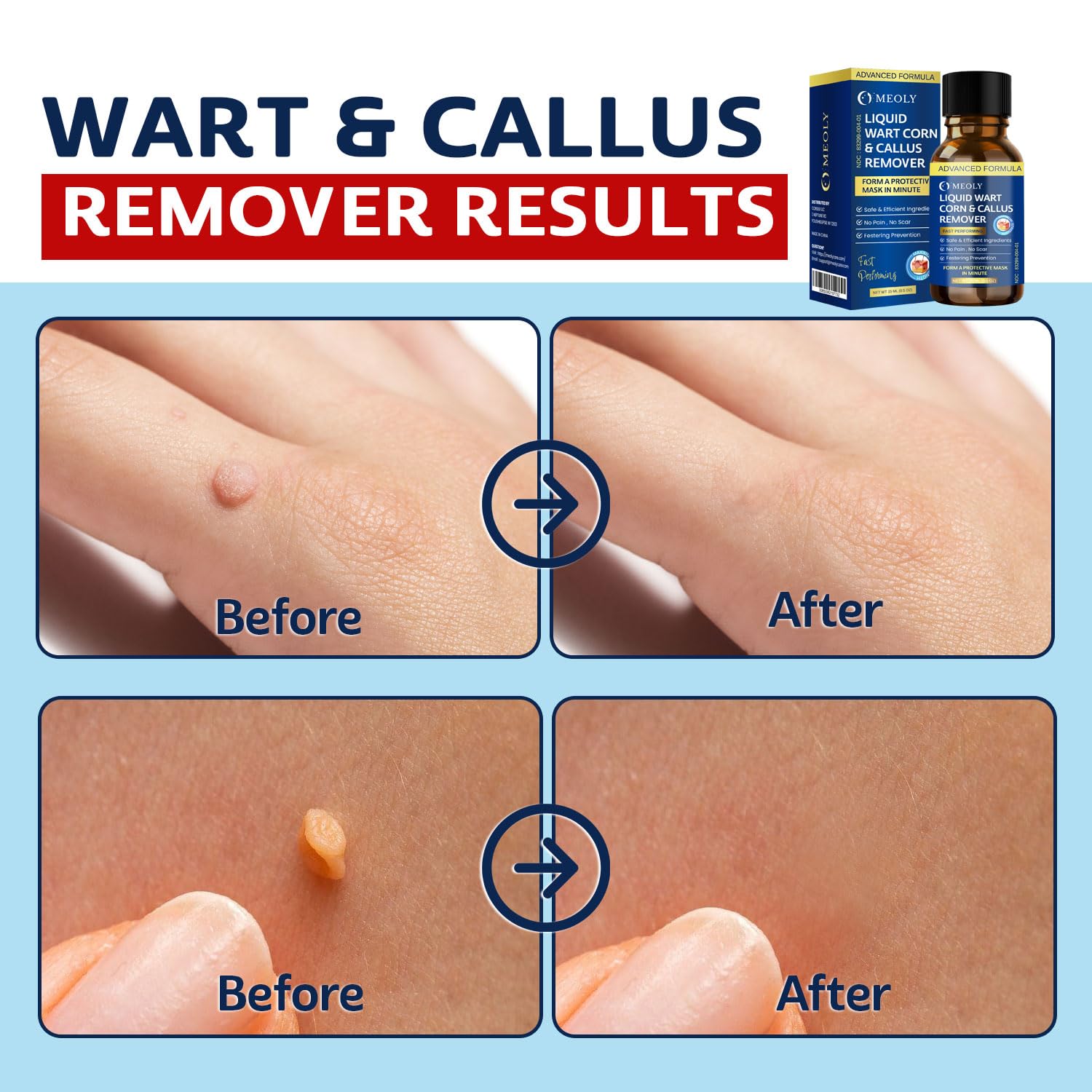MEOLY mask covers a plantar wart area, showing precise surface coverage.