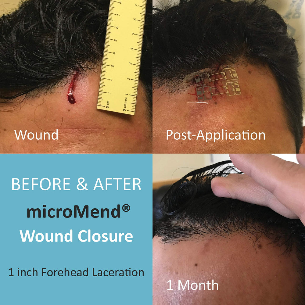 An athlete-friendly tool for quick wound closure after activity.