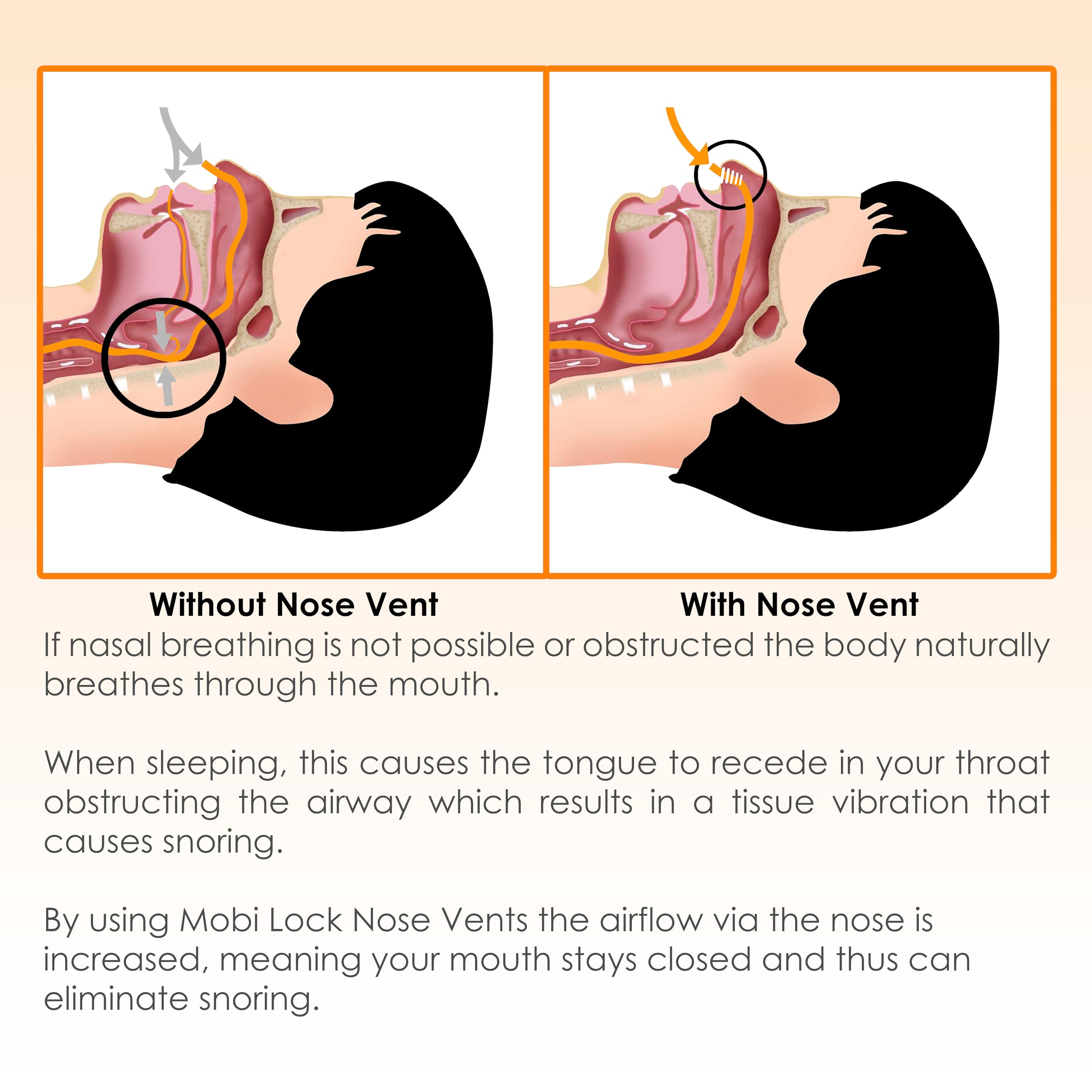 Mobi Lock Nose Vent full-night wear for comfortable nasal breathing.