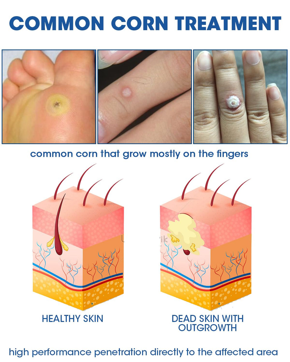 MYMULIKE foot care illustration highlighting safe use on corn areas.