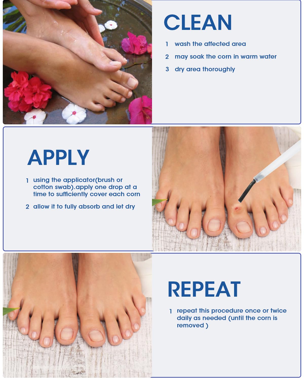 MYMULIKE corn remover applied to toes for targeted corn relief.