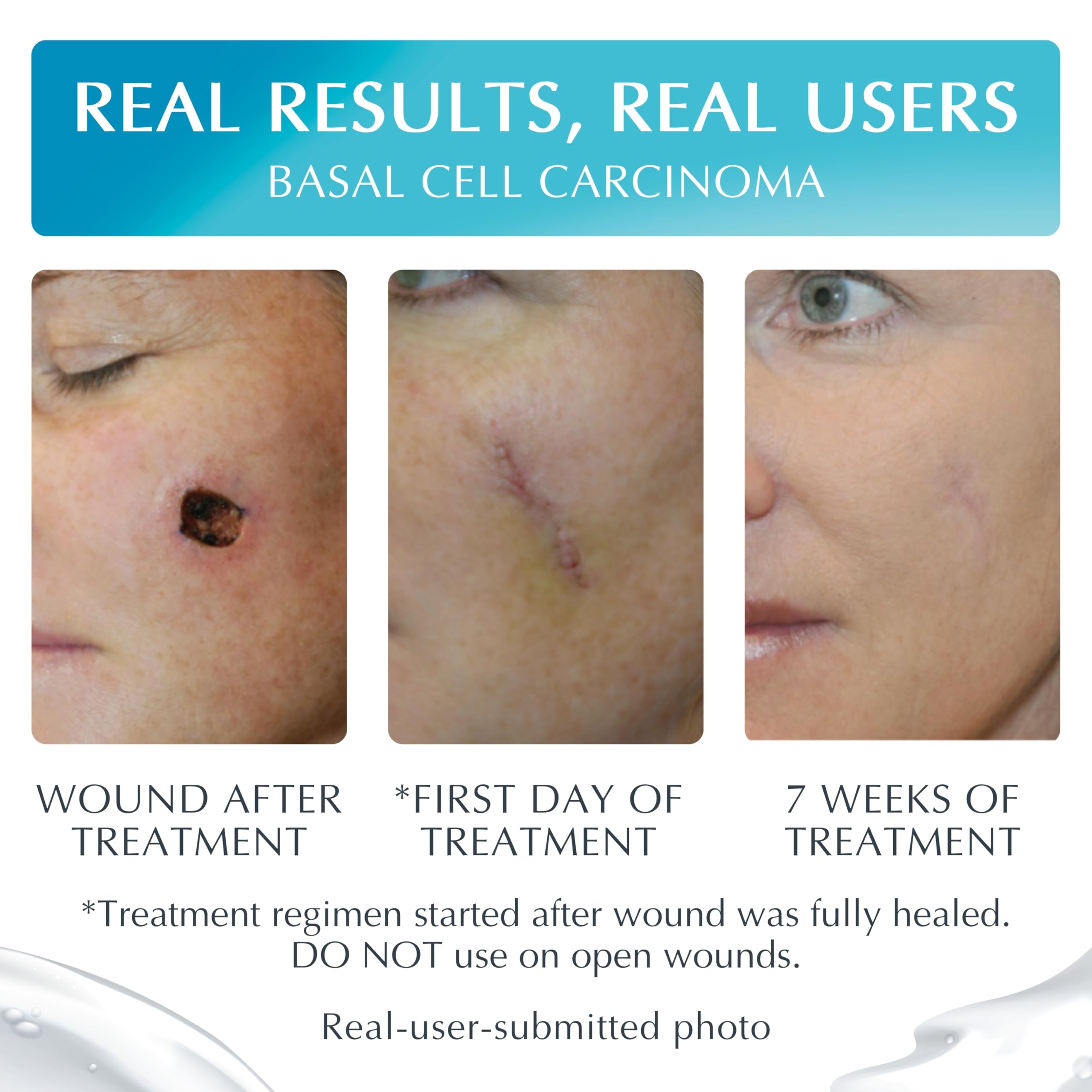 MyNewGel Plus Scar Gel applied to a scar for tactile smoothing