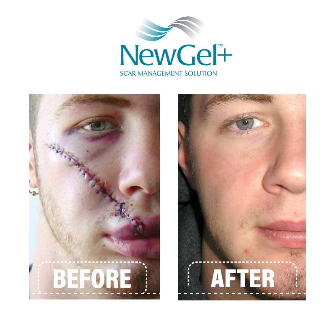 Daily scar care routine with MyNewGel NewGel Plus Scar Gel