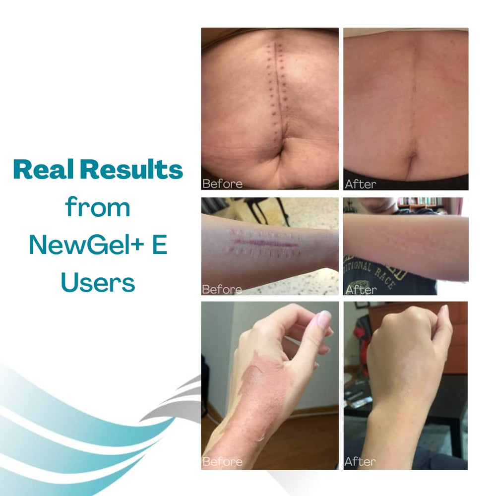 Product box of MyNewGel Plus Scar Gel with usage guidance