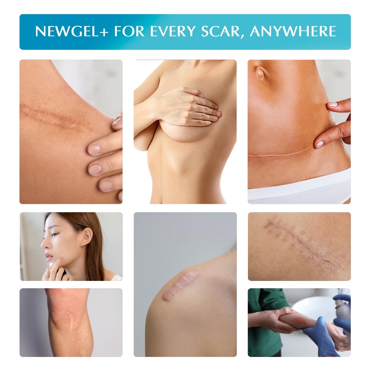 MyNewGel packaging and four sheets shown for home treatment