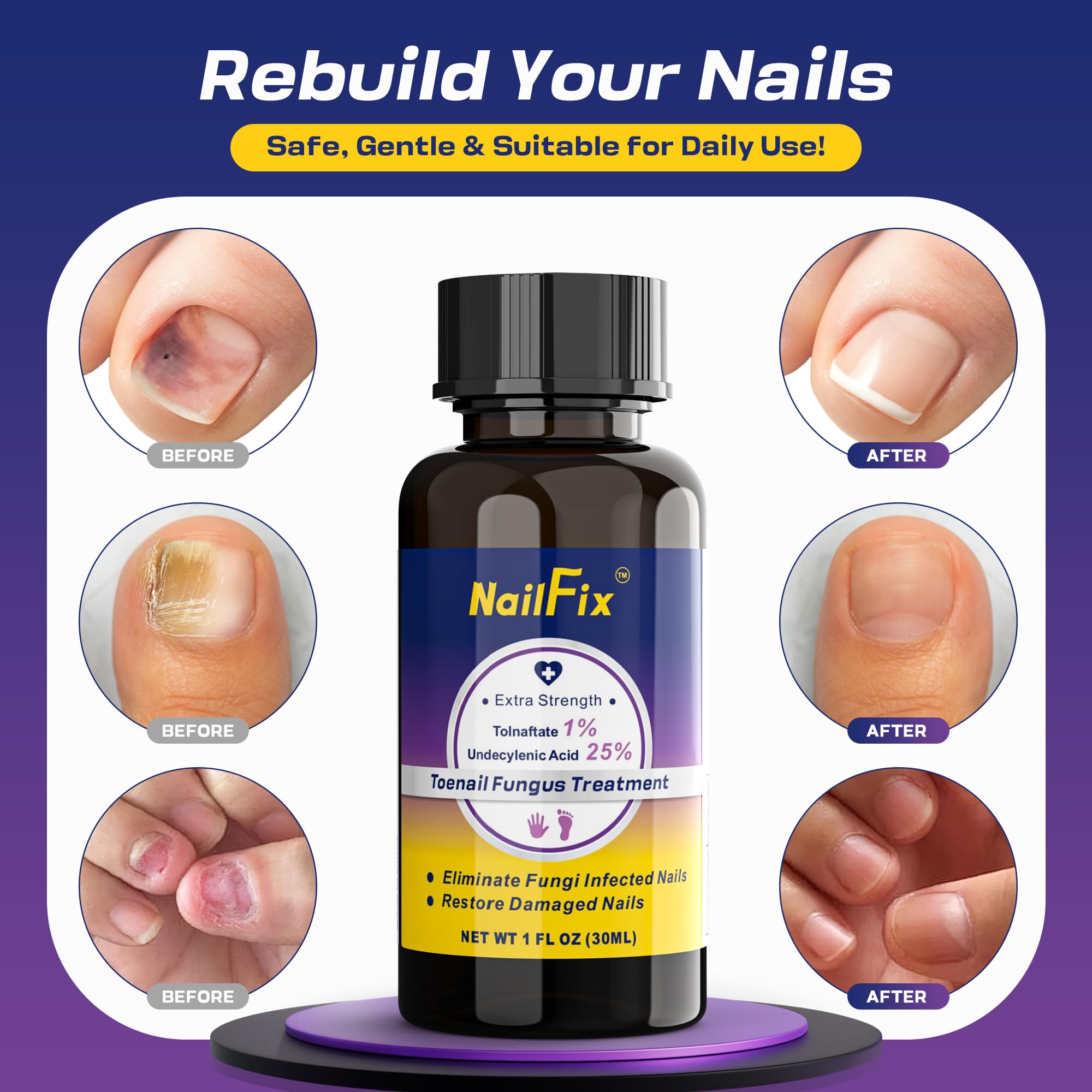 NailFix packaging box highlights 25% undecylenic acid and 1% terbinafine.